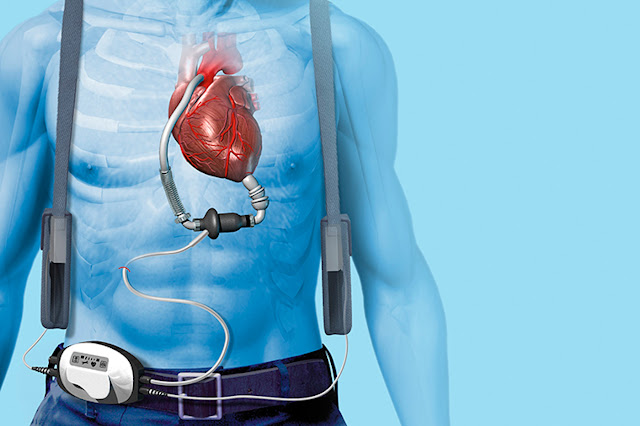 Cardiac Assist Devices