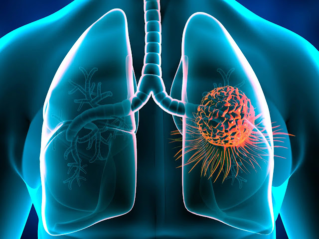 Lung Cancer Therapeutics Market