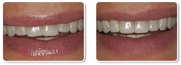 http://hyderabad-dentist.com/cosmetic-dentistry-enamel-shaping.php