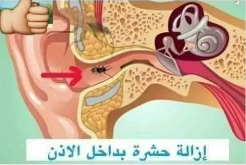 الطريقة الطبية الصحيحة لازالة حشرة من داخل الأذن