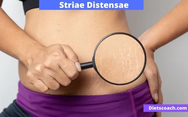 Striae Distensae