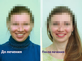 Улыбка пациента до и после исправления центра зубов