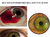 Derrame En El Ojo Por Presion Alta