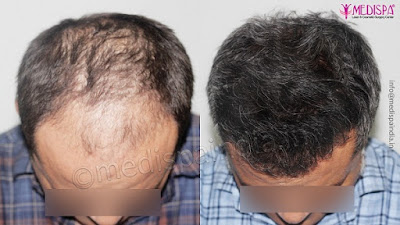 Hair Transplant in India