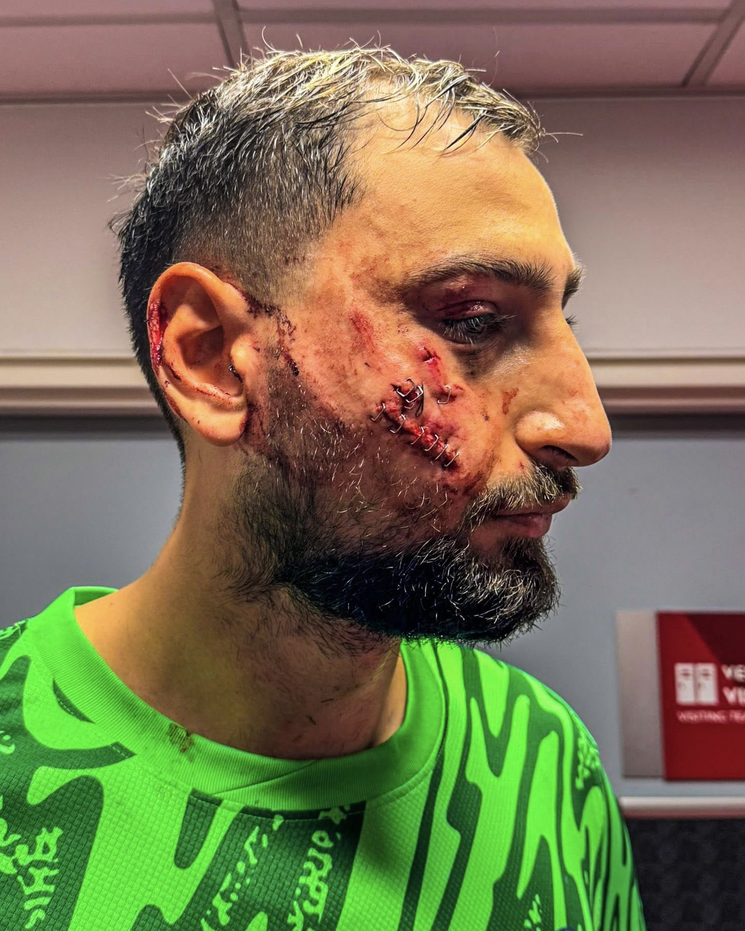PSG goalkeeper, Gianluigi Donnarumma, suffered face injuries after clash with Monaco's Singo on Wednesday night