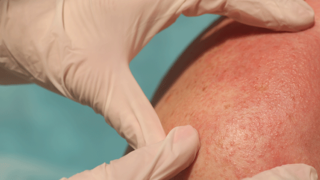 أفضل 9 طرق لعلاج حساسية الجلد في المنزل