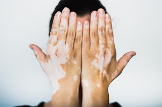 Vitiligo belirtileri