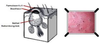 tips menghilangkan komedo 