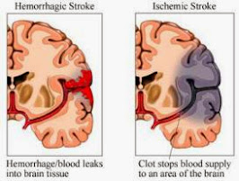 What Is Stroke