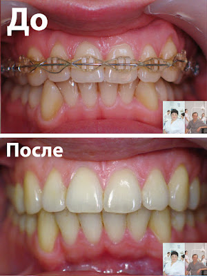 улучшение состояния десны после брекетов