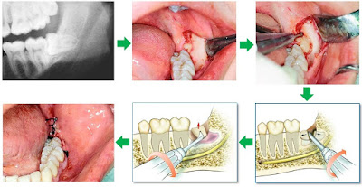 Nhổ răng khôn có xảy ra biến chứng không?