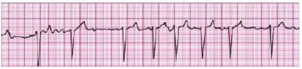 Figura I - Traçado eletrocardiográfico.