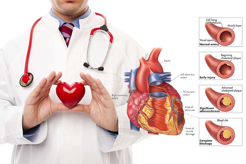 16+ Penyebab Jantung Koroner, Paling Baru!