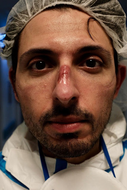Retrato de um enfermeiro com o nariz machucado pelo uso contínuo da máscara de proteção.