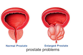prevent prostate problems naturally