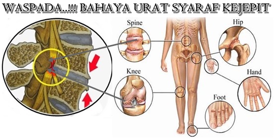 Mengenal lebih dekat tentang Saraf Kejepit? Apa Penyebabnya dan Bagaimana Gejalanya?