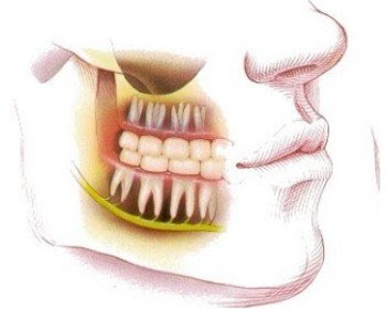 Răng khôn mọc lệch ra má phải làm gì?