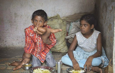 10 Gambar Budak Terkena Penyakit Tangan Gergasi Di India 