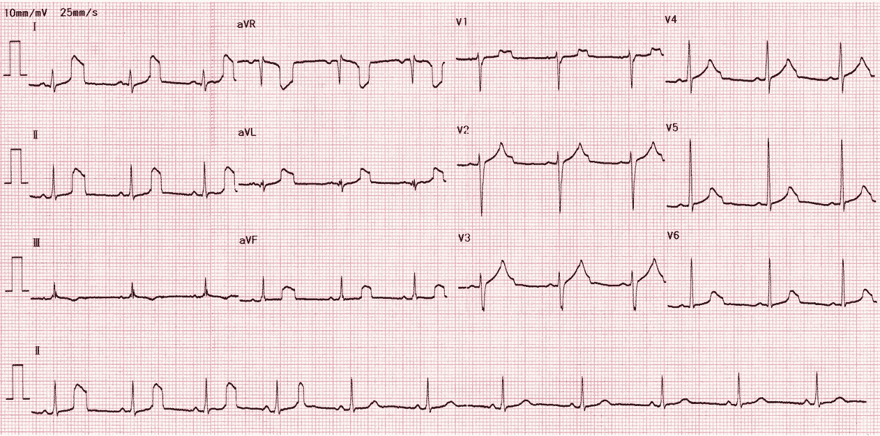 Смэкг что это. Пульсовой артефакт на ЭКГ. Артефакты на кардиограмме сердца. Избыток магния на ЭКГ. Сосудистые артефакты на ЭКГ.