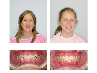 Orthodontist Dr. Mole in Milwaukee, WI and Racine, WI before and after with patients