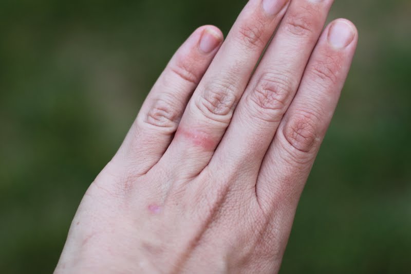 Wedding Ring Dermatitis