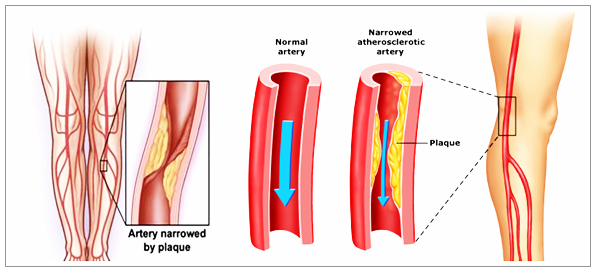 Cara Mengobati Penyakit Arteri Perifer Secara Tradisional