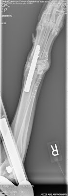 Coreys X RAY showing the metal plate in his wrist