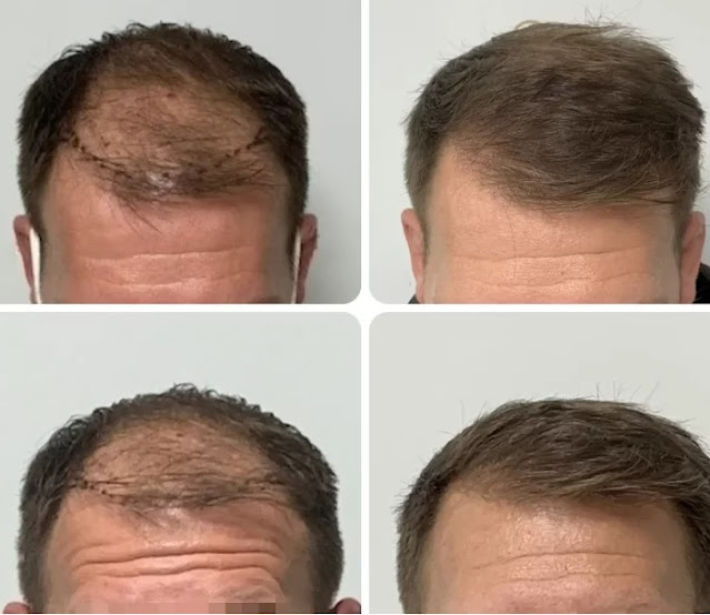 Trapianto di capelli prima e dopo di un uomo di 37 anni presso la clinica di Trapianto Capelli Albania a Tirana