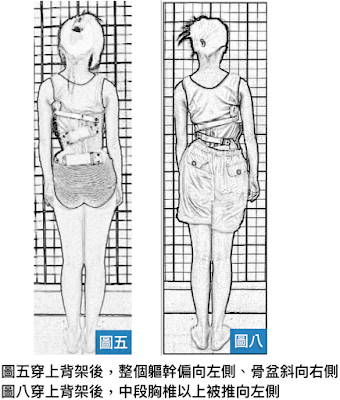 脊椎側彎, 脊椎側彎矯正, 脊椎側彎治療, 脊椎側彎矯正運動, 脊椎側彎 瑜珈, 脊椎側彎復健