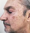 How to remove blemishes from the face ?