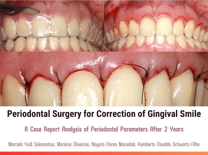 PDF: Periodontal Surgery for Correction of Gingival Smile: a Case Report Analysis of Periodontal Parameters After 2 Years