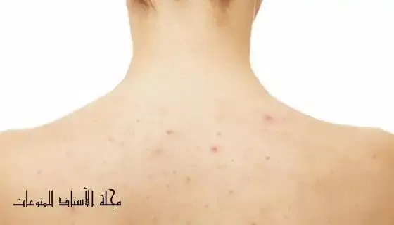 Here-are-natural-remedies-to-get-rid-of-body-pimples