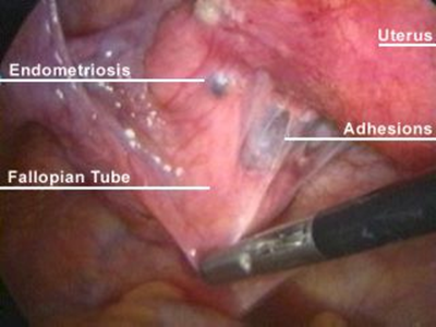 ENDOMETRIOSIS