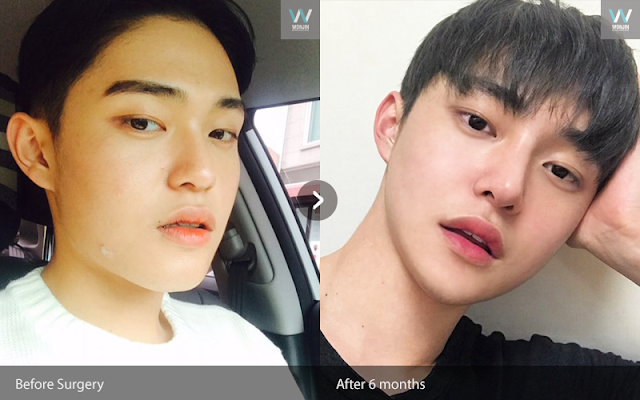 짱이뻐! - Popular Plastic Surgery Review For Male Patients