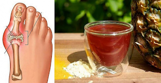 Remove Uric Acid Crystals From The Body