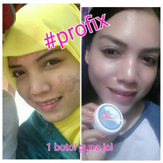 ProFix Vitamin Muka Berlubang: PROFIX- Krim Parut Jerawat 