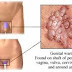 Cara Menyembuhkan Kutil Kelamin Pada Pria