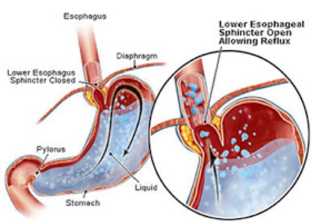 Gerd Bukan Gastrik