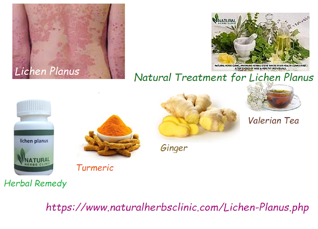 Natural-Treatment-for-Lichen-Planus