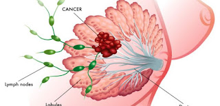 Obat Penghancur Tumor