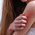 What Are the Different Types of Eczema?