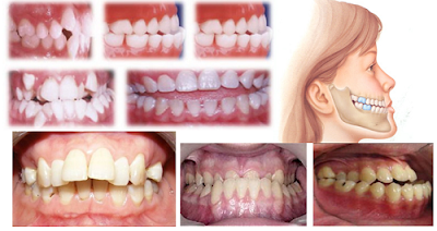 Nguyên nhân răng móm là gì? 