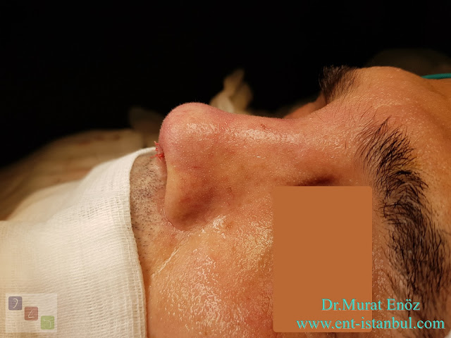 Male Rhinoplasty,Revision Rhinoplasty Operation With Rib Cartilage,Tertiary Revision Nose Aesthetic Surgery,Tertiary Revision Nose Job in Istanbul,