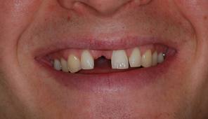 Dental implants Arizona