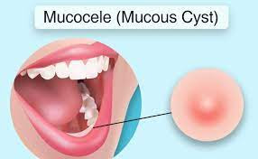 Mucocele