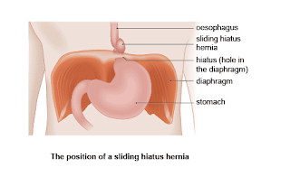 Hiatus Hernia Info: Baby Hiatus Hernia Symptoms