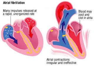 Cardiac Arrhythmias