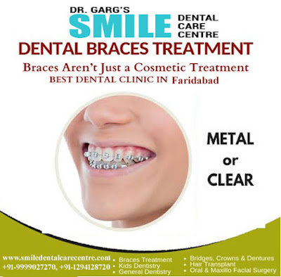 Best Braces Treatment in Faridabad