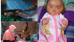 Terkendala Biaya, Bayi Hidrosefalus Batal Ke Makassar Hari Ini