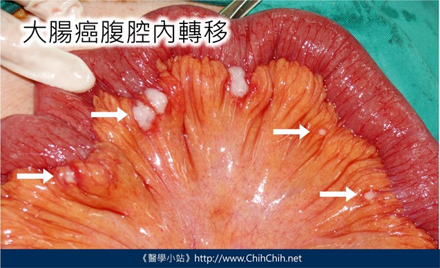 大腸癌多處轉移